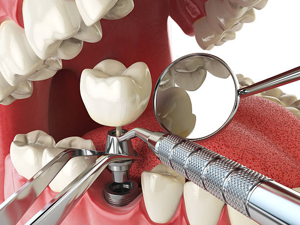 Best Emergency Tooth Extraction in King, NC